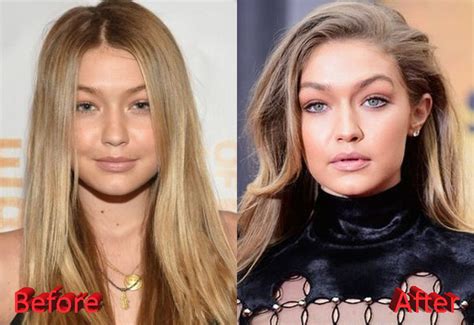 gigi hadid plastic surgery|Gigi Hadid Before and After Plastic Surgery: Boobs,。